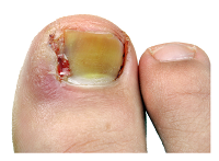 infected ingrown toenail